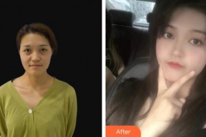 龙口光明眼科医院满辉整形价格表附眼部综合案例展示