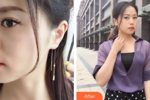 龙口光明眼科医院李超英整形价格表附激光去黑眼圈案例展示