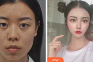 龙口光明眼科医院李健整形价格表附眼部综合案例展示