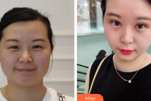 龙口光明眼科医院金震整形价格表附定点双眼皮案例展示