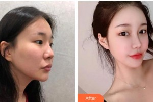 龙口光明眼科医院胡聪整形价格表附眼部综合案例展示