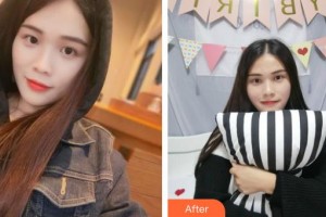 临海市中医院整形外科盛于华整形价格表附切开双眼皮案例展示