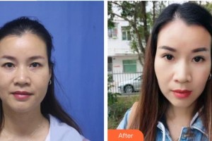 鹿邑眼科医院刘志才整形价格表附激光去黑眼圈案例展示