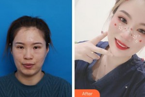 鹿邑眼科医院李金荣整形价格表附激光去眼袋案例展示