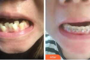 济源向日葵口腔门诊部李斌整形价格表附金属托槽矫正案例展示