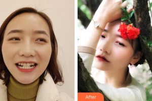 济源霍氏口腔医院霍心海整形价格表附金属托槽矫正案例展示