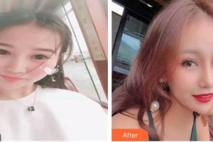 大理华山眼科医院洪卫整形价格表附切开双眼皮案例展示