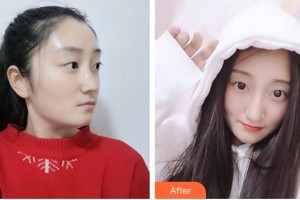 唐河东方眼科医院袁育新整形价格表附眼部综合案例展示