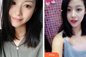 唐河东方眼科医院李斌整形价格表附切开双眼皮案例展示