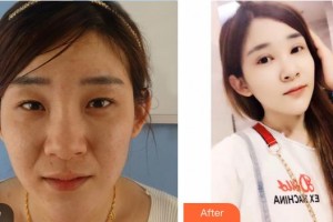 唐河东方眼科医院贾志军整形价格表附眼部综合案例展示