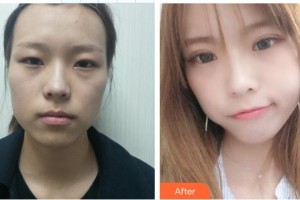 唐河东方眼科医院杨华岳整形价格表附切开双眼皮案例展示