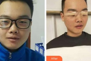 唐河东方眼科医院袁献华整形价格表附眼部综合案例展示