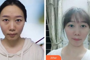 唐河东方眼科医院张清勇整形价格表附激光去眼袋案例展示