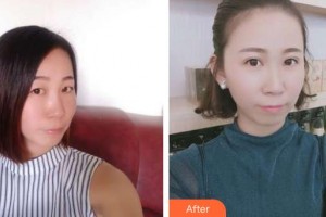 唐河东方眼科医院白珣整形价格表附切开双眼皮案例展示