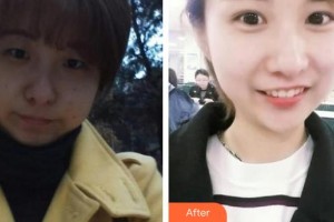 郯城新益民眼科医院田作龙整形价格表附眼部综合案例展示