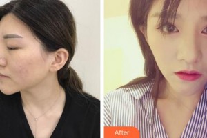 郯城新益民眼科医院魏宁整形价格表附定点双眼皮案例展示