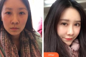 郯城新益民眼科医院王涛整形价格表附切开双眼皮案例展示