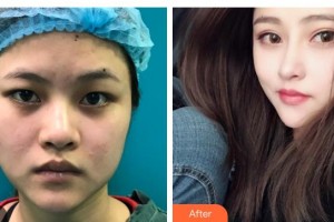 郯城新益民眼科医院赵阳整形价格表附切开双眼皮案例展示