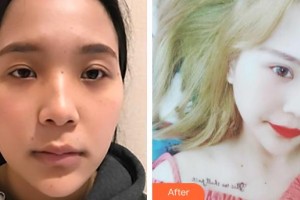 郯城新益民眼科医院李光达整形价格表附切开双眼皮案例展示