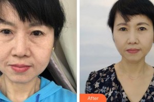 郯城县第一人民医院眼科孙虹整形价格表附外切祛眼袋案例展示