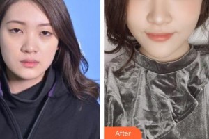 郯城新益民眼科医院解孝峰整形价格表附切开双眼皮案例展示