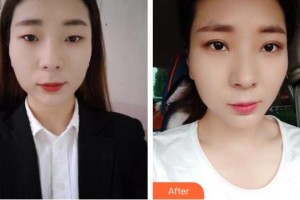 邯郸京美整形医院张丙海整形价格表附眼部综合案例展示