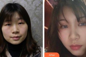 邯郸京美整形医院张炜整形价格表附眼部综合案例展示