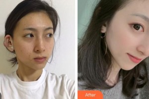 邯郸京美整形医院杜艳整形价格表附激光祛斑案例展示