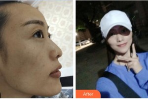 邯郸市第七医院整形科刘香梅整形价格表附激光祛斑案例展示