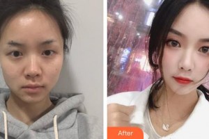 邯郸华美医疗美容医院姜胜勋整形价格表附红蓝光祛痘案例展示