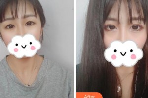 邯郸中信皮肤科门诊部史慧萍整形价格表附眼部综合案例展示