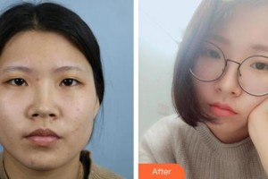 邯郸中信皮肤科门诊部韩振涛整形价格表附切开双眼皮案例展示