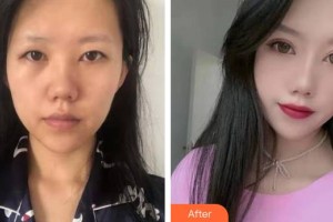 邯郸金皇后医疗美容诊所张爱花整形价格表附眼部综合案例展示