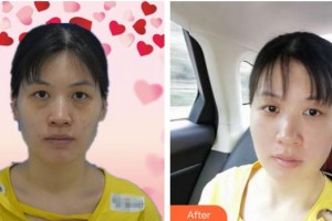 邯郸贝洁口腔医院李东娟整形价格表附眼部综合案例展示