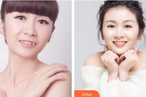 邯郸佑熙医疗美容门诊部孙坚整形价格表附隐形托槽矫正案例展示