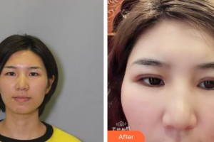 汉口爱尔眼科医院刘兵整形价格表附眼部综合案例展示