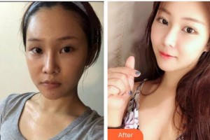 汉口爱尔眼科医院曾庆延整形价格表附眼部综合案例展示