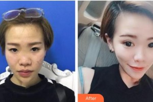 汉口爱尔眼科医院范文雨整形价格表附眼部综合案例展示