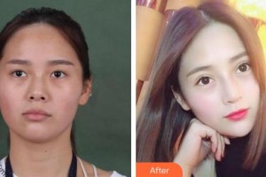 汉口爱尔眼科医院谭维娜整形价格表附切开双眼皮案例展示