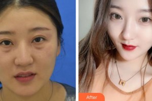 汉口爱尔眼科医院杜芳整形价格表附激光去眼袋案例展示