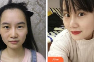 汉口爱尔眼科医院陈英整形价格表附眼部综合案例展示