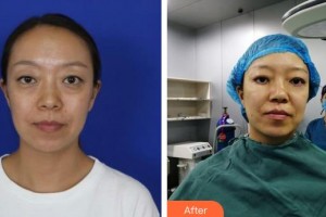 汉口爱尔眼科医院罗恒清整形价格表附外切祛眼袋案例展示