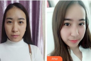 汉口爱尔眼科医院谢小华整形价格表附切开双眼皮案例展示