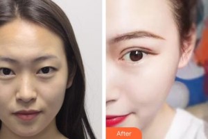 汉口爱尔眼科医院郑亦君整形价格表附切开双眼皮案例展示