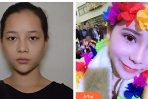 汉口爱尔眼科医院周贤芝整形价格表附眼部综合案例展示