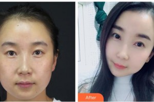 汉口爱尔眼科医院王浩宇整形价格表附眼部综合案例展示