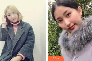 汉口爱尔眼科医院郑一晨整形价格表附眼部综合案例展示