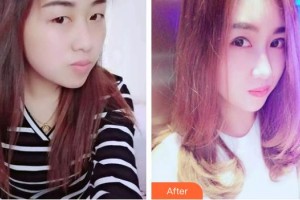 湘西丽人整形美容医院徐娟整形价格表附切开双眼皮案例展示