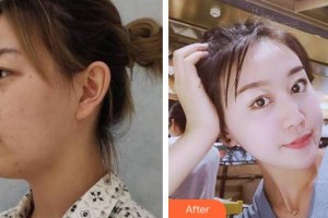 湘西爱尔眼科医院谭米特整形价格表附眼部综合案例展示