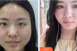 湘西爱尔眼科医院曾山秀整形价格表附定点双眼皮案例展示